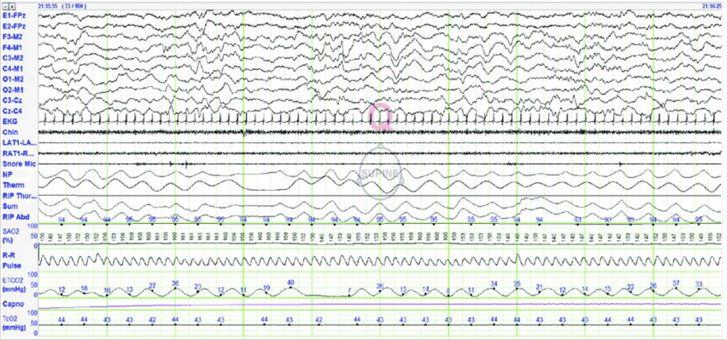 Polysomnography EEG